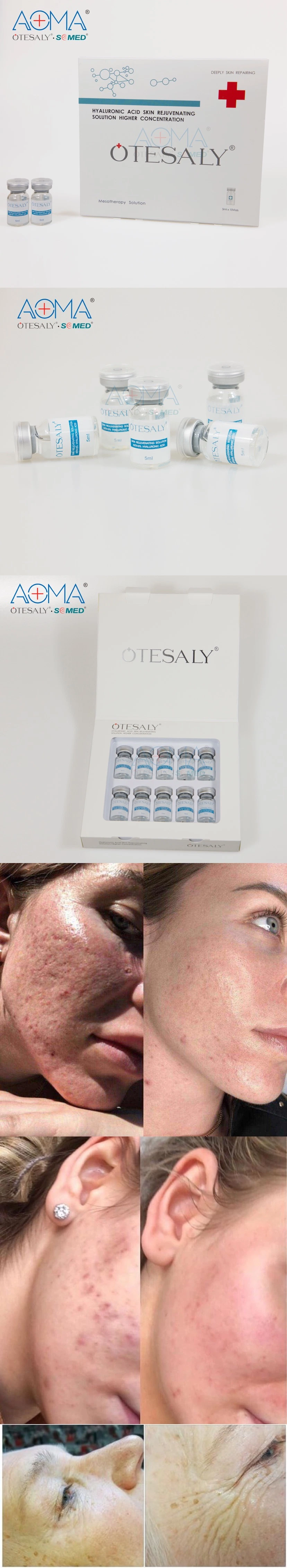 Otesaly Injectable Whitening Product Injection Mesotherapy and Anti-Wrinkle Whitening Liquid